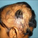 Metody leczenia łysienia plackowatego dzieci