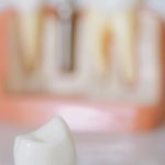 Implanty zębów: Nowoczesne rozwiązanie dla zdrowego uśmiechu